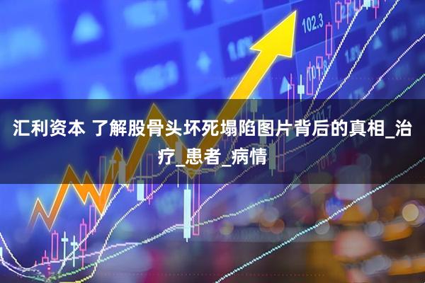 汇利资本 了解股骨头坏死塌陷图片背后的真相_治疗_患者_病情